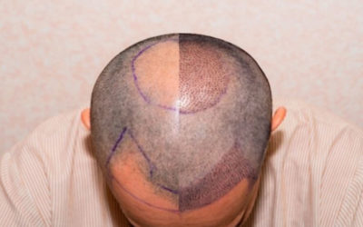 microtransplante-cabello